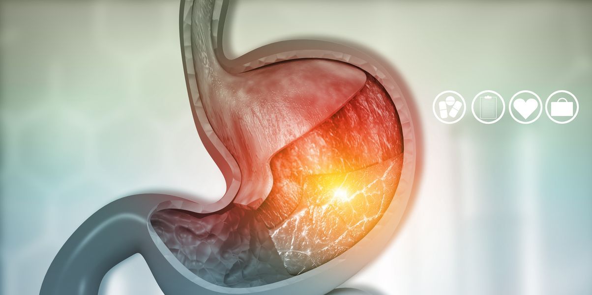 Bono PAD manga gástrica