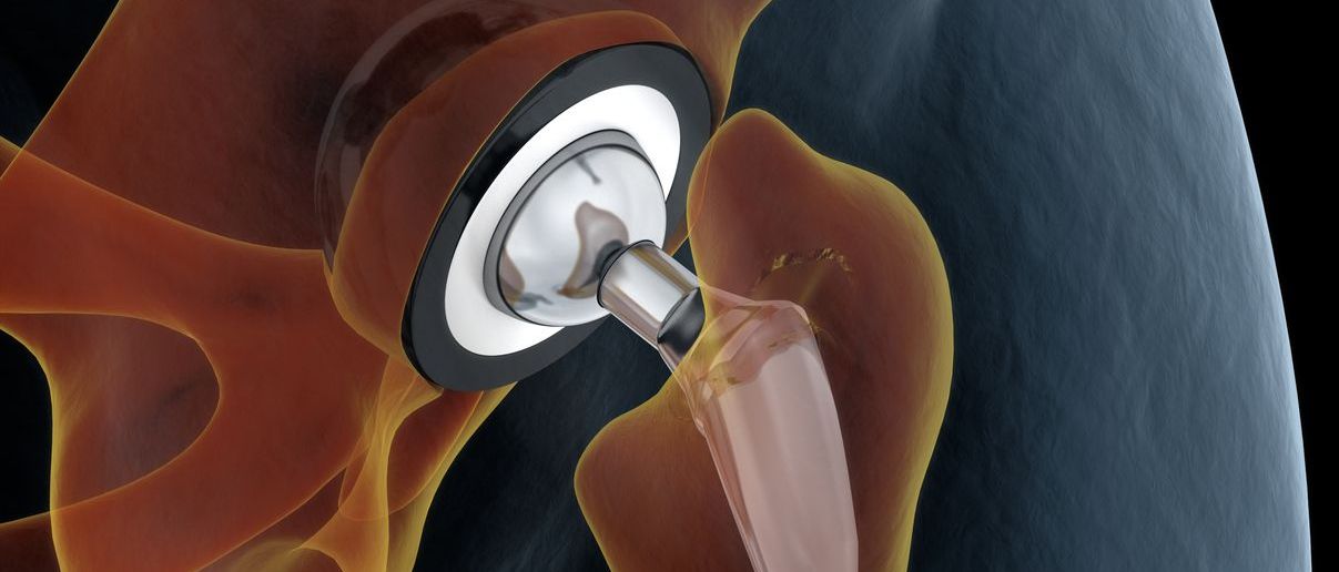 Tu cirugía de prótesis de cadera con SAP Fonasa